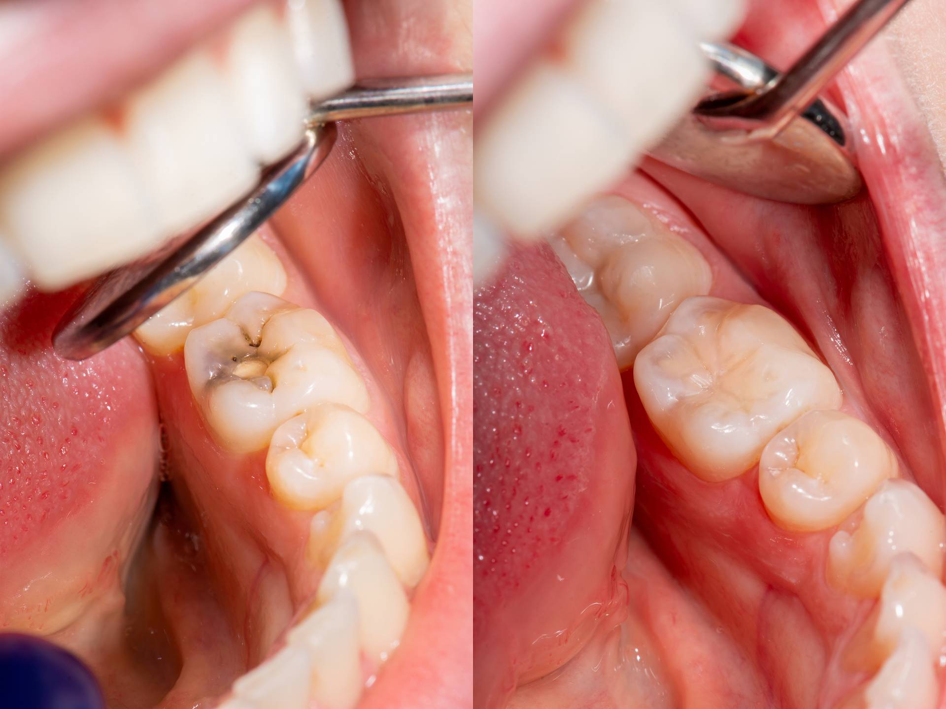 Ein Bild zeigt eine Karies am Zahn. Das zweite Bild zeigt den gefüllten Zahn